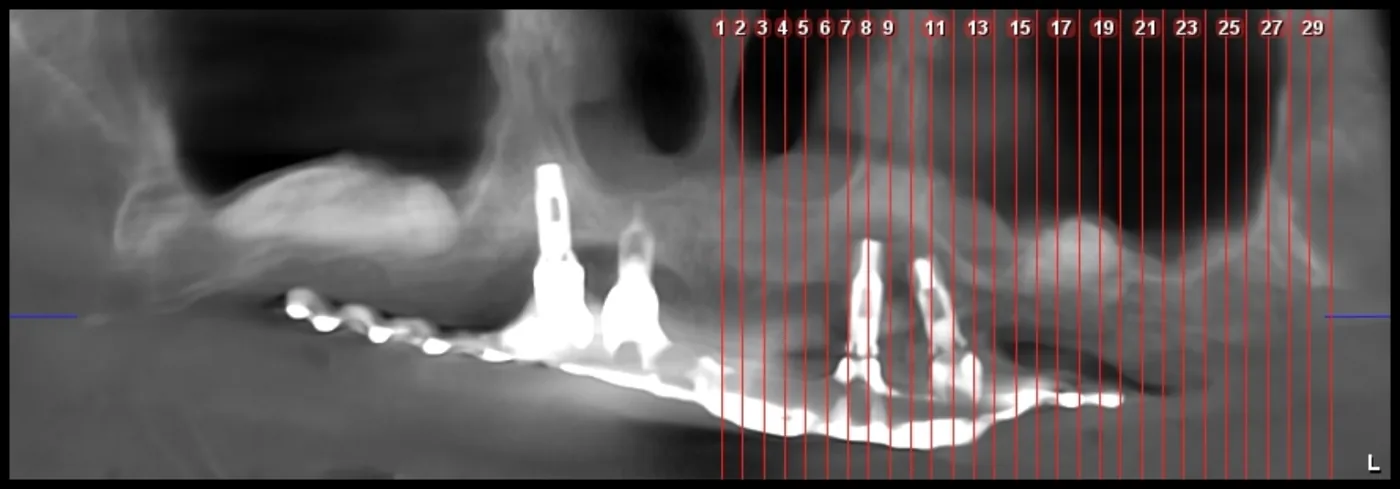 Tomografía de un maxilar con pérdida ósea severa
