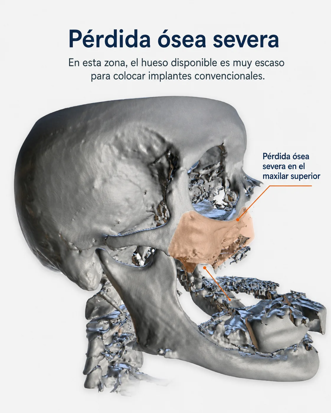 Ejemplo explicativo de pérdida ósea severa del maxilar superior